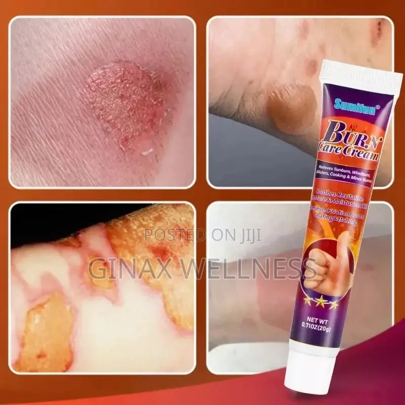 Burn Care Cream | Herbal Cream for Burns, Scalds Blisters