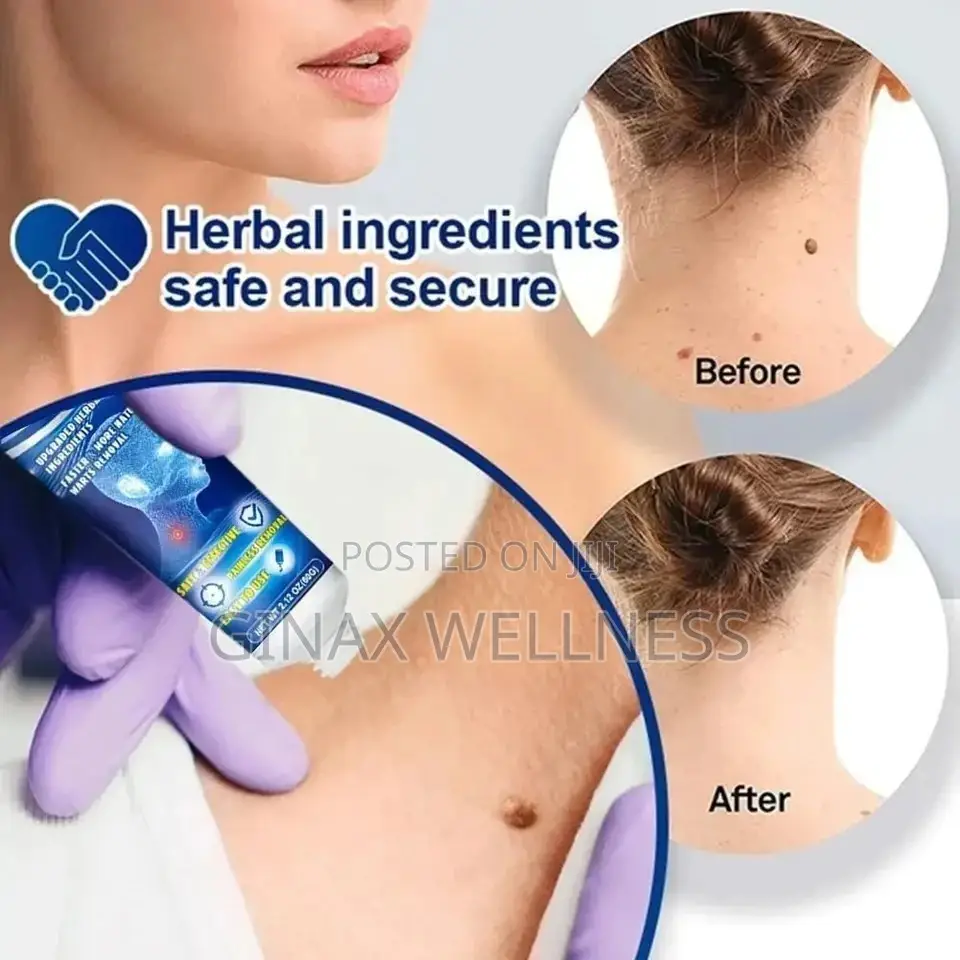 Warts Remover Cream (3x Size, 60grams) for Skin Tags Warts