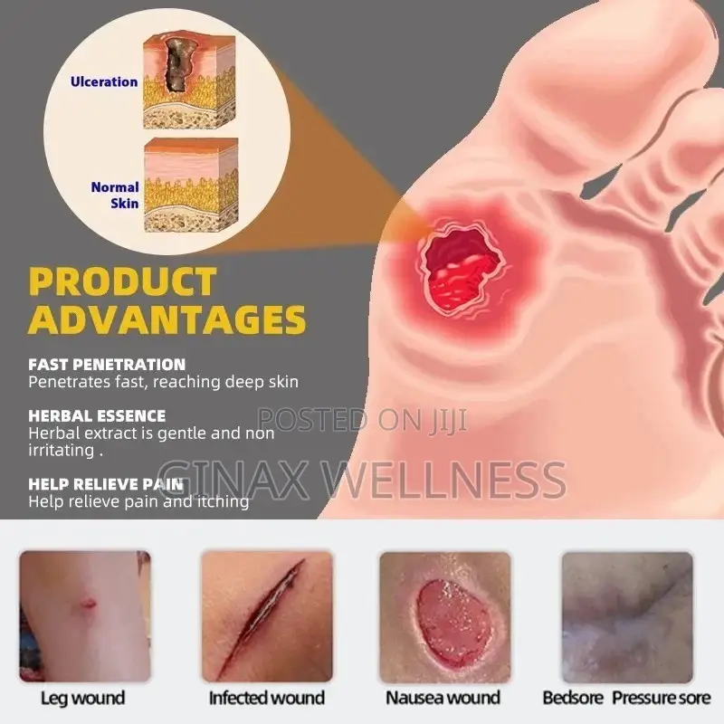 Bed Sores Cream for Decubitus Ulcers, Wounds Pressure Ulcers