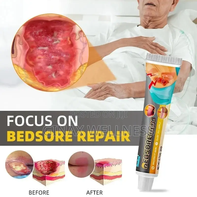 Bed Sores Cream for Decubitus Ulcers, Wounds Pressure Ulcers