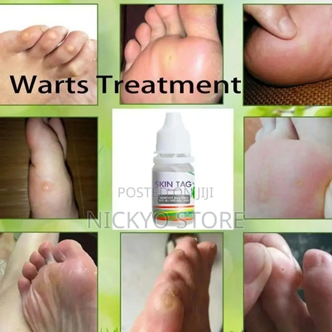 Skin Tag Removal