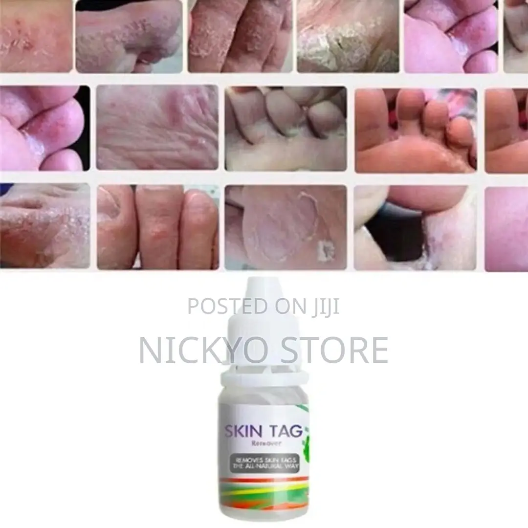 Skin Tag Removal