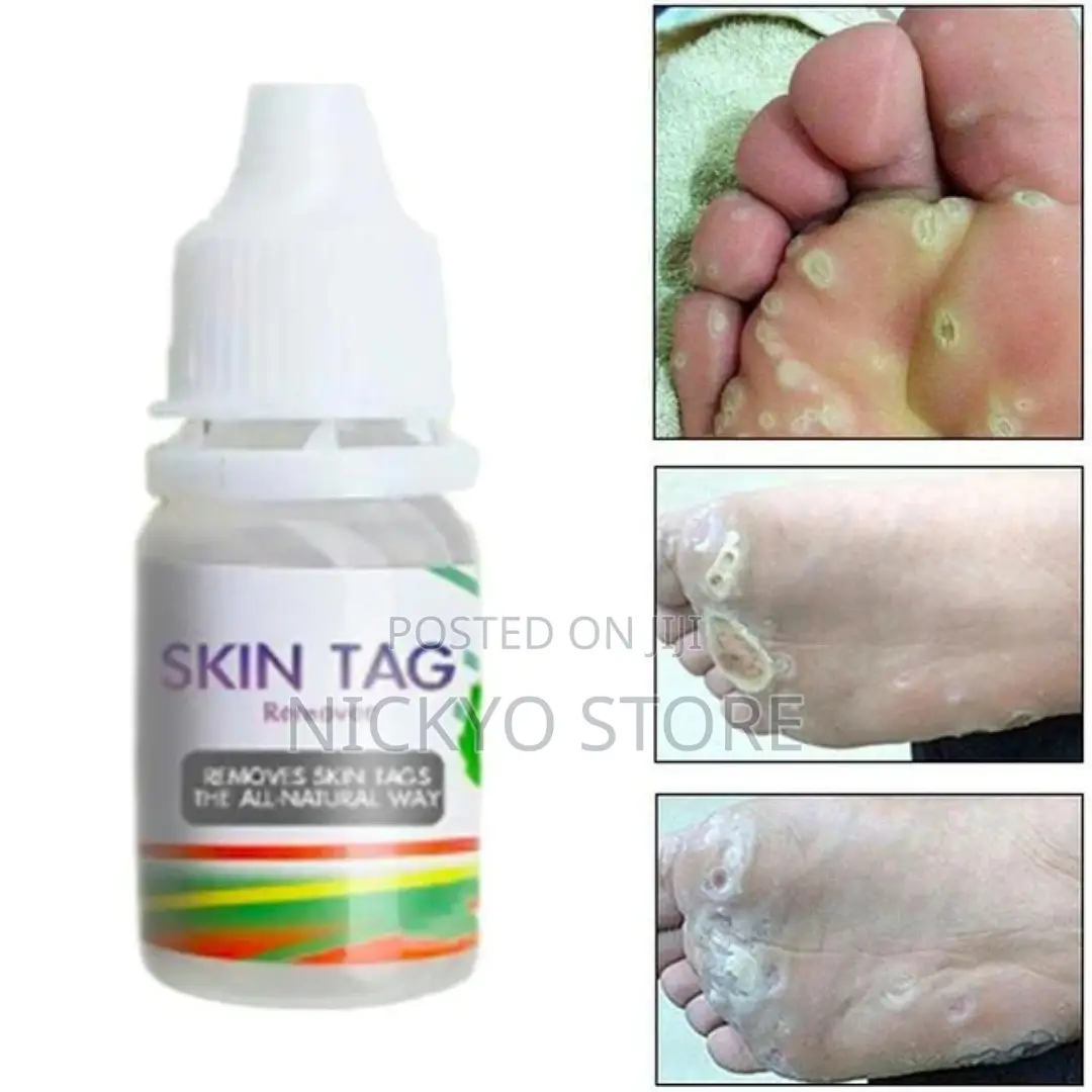 Skin Tag Removal