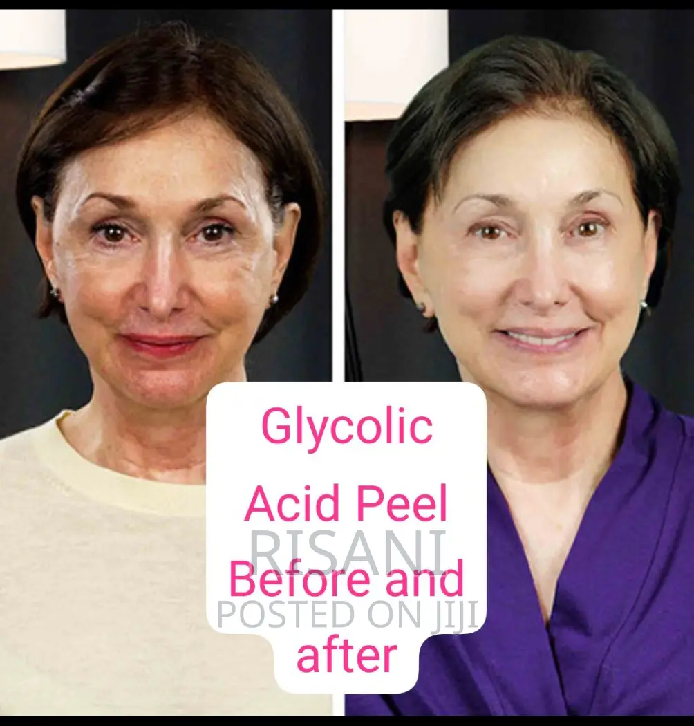 Glycolic Acid Peel