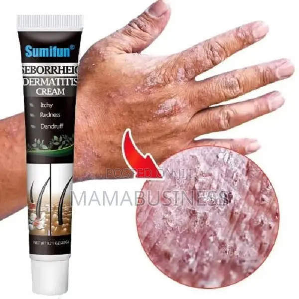 Seborrheic Dermatitis Cream - 20g