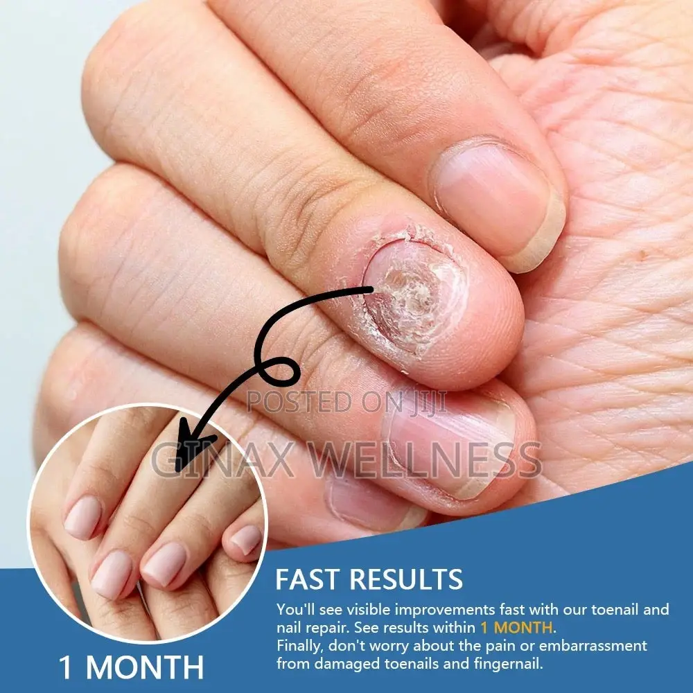 Nail Fungus Relief Spray | Topical Spray for Infected Nails