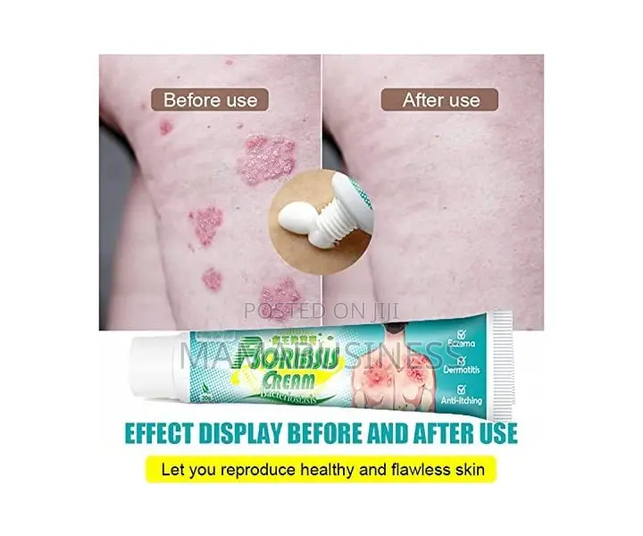Kanye HB Psoriasis Cream Bacteriostasis - 20g