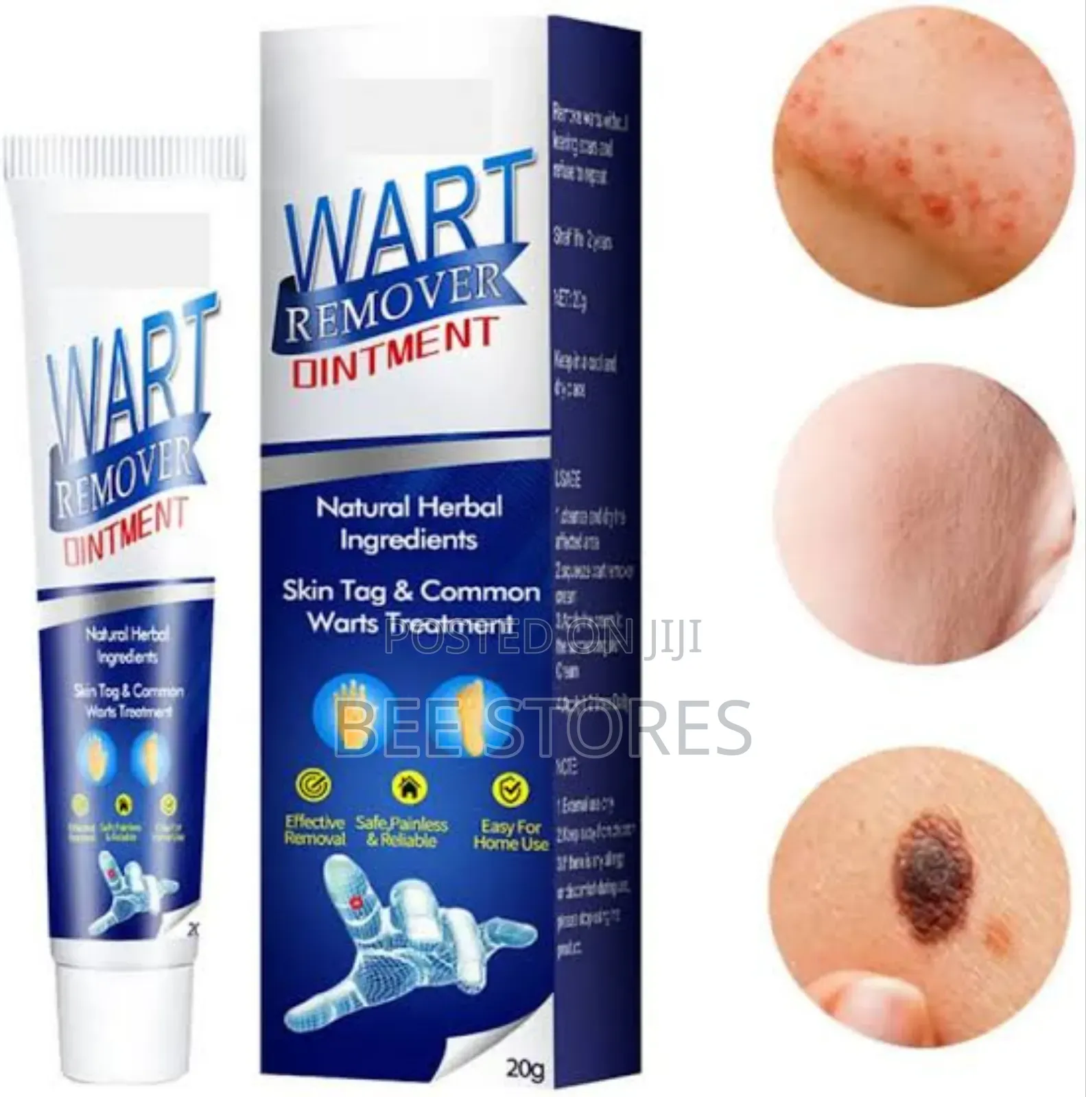 Skin Tag Wart Removal Ointment