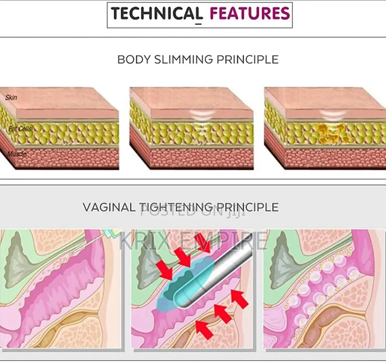 Hifu Focused Ultrasound Vaginal Tightening Machine
