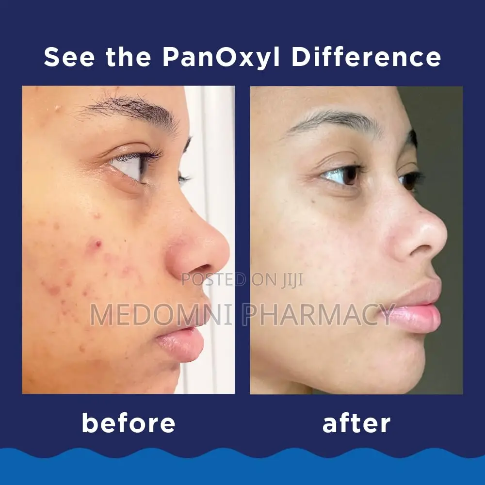 Panoxyl Acne Foaming Wash 156g