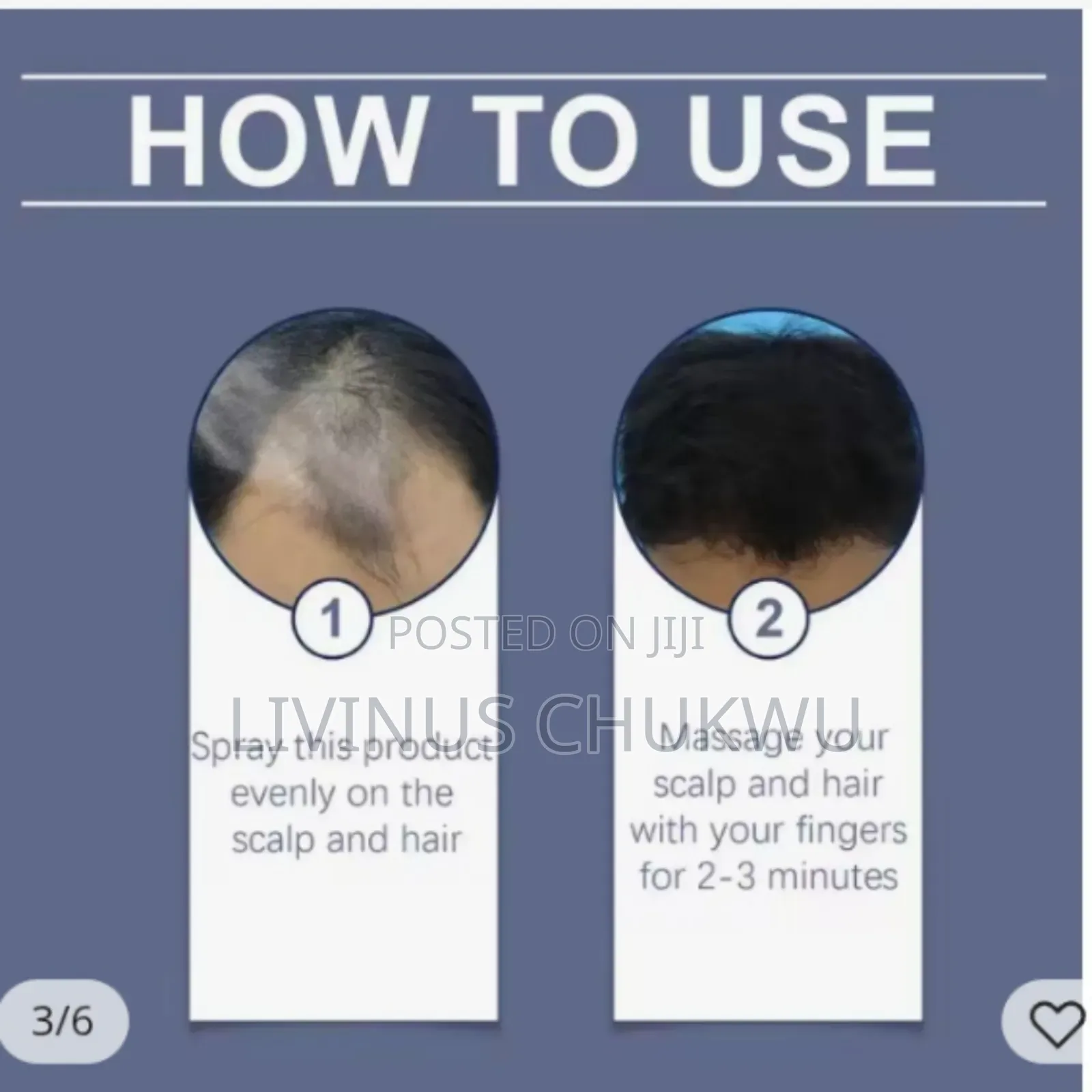 Effective Hair Growth With 6% Minoxidil for Both Men and Women