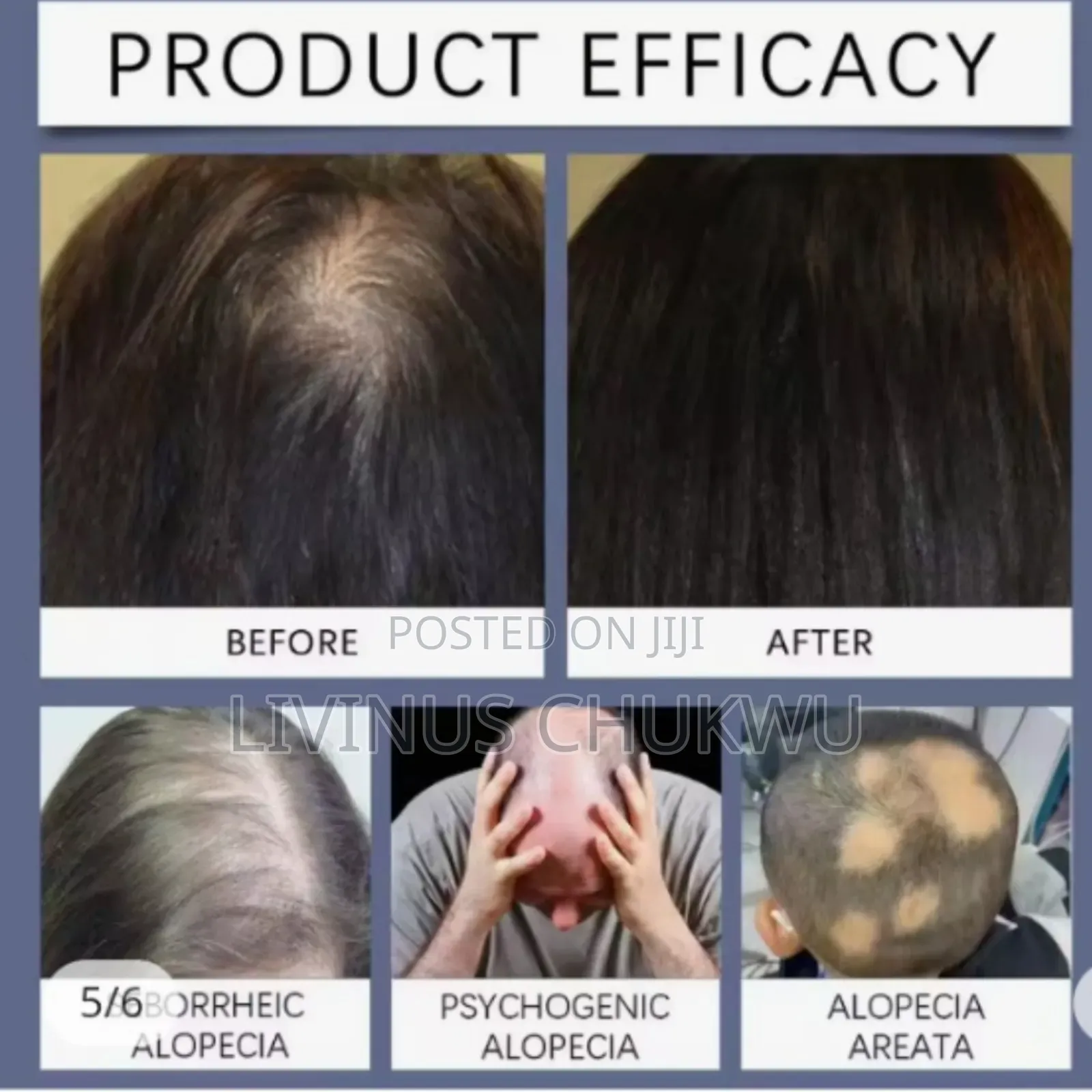 Effective Hair Growth With 6% Minoxidil for Both Men and Women