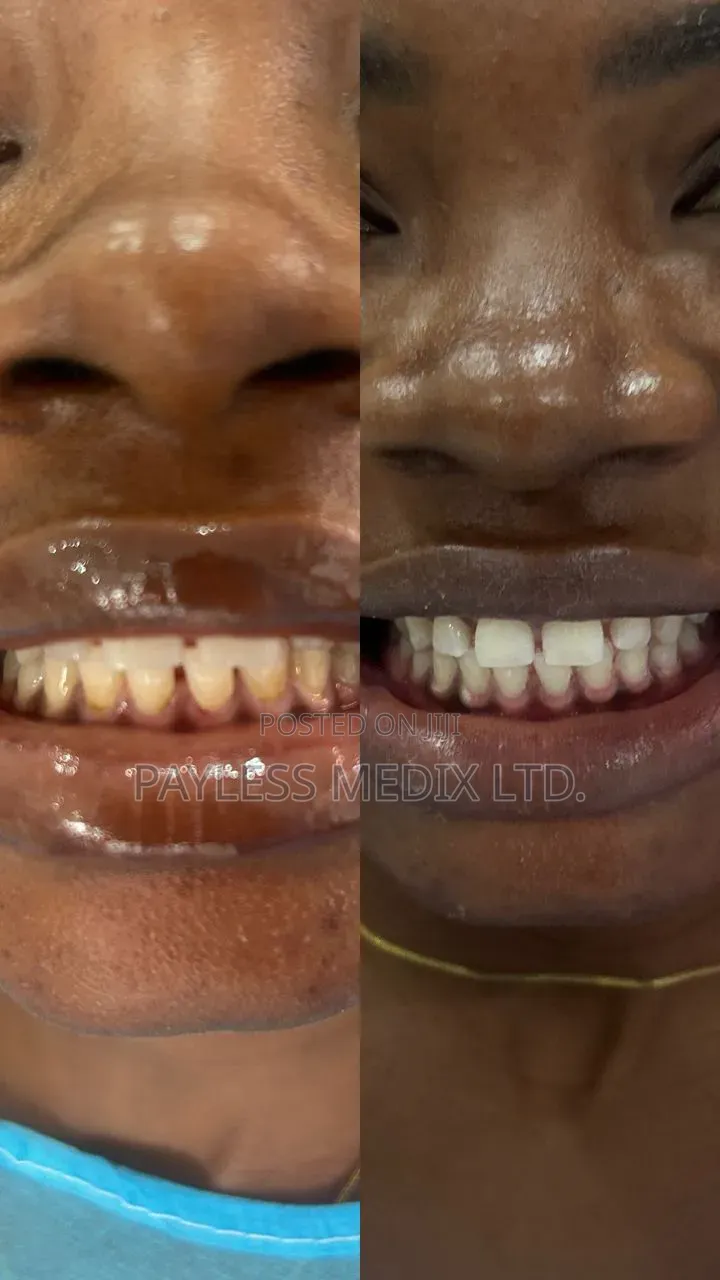 Teeth Whitening Services