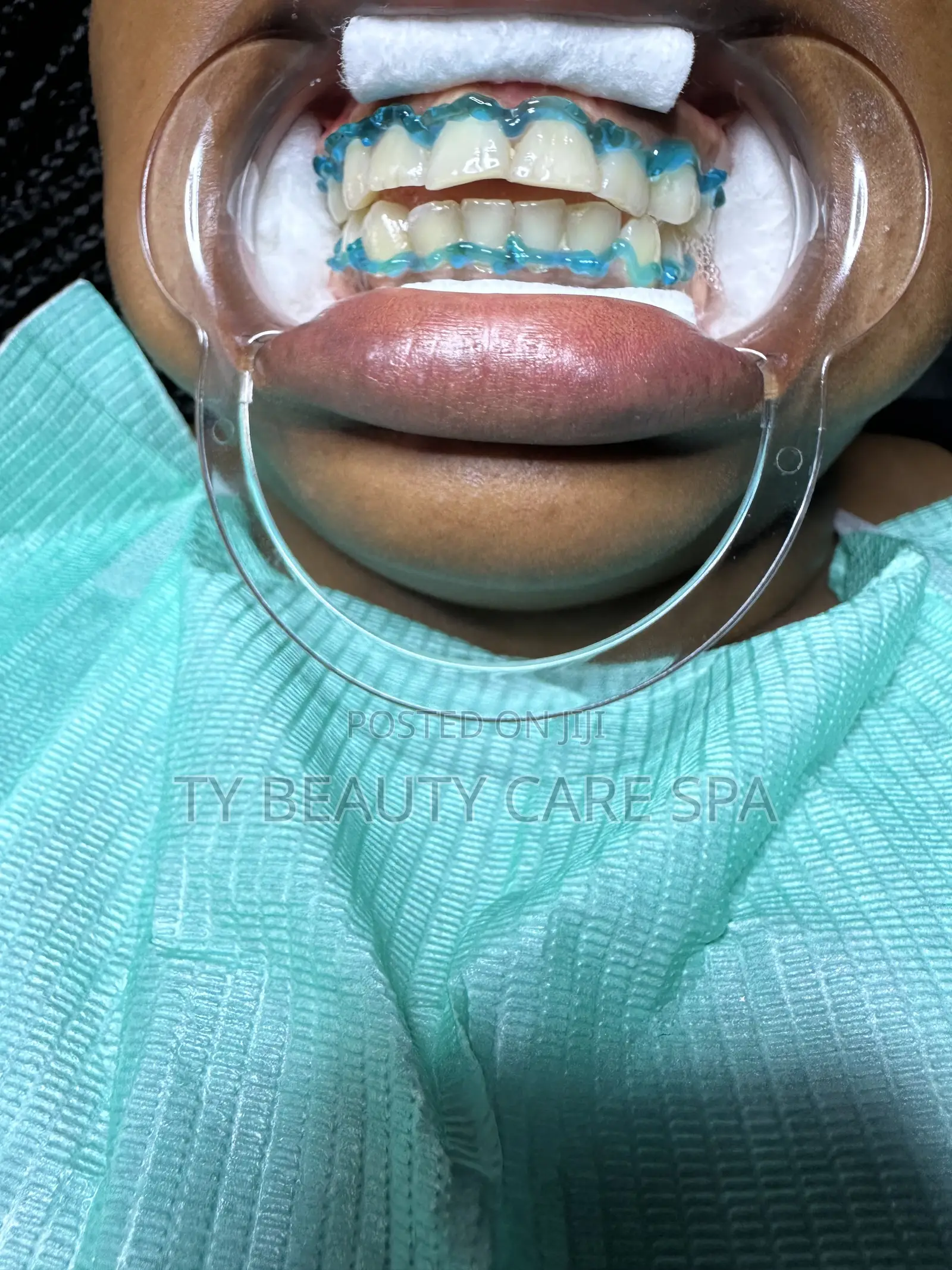 Teeth Whitening Session