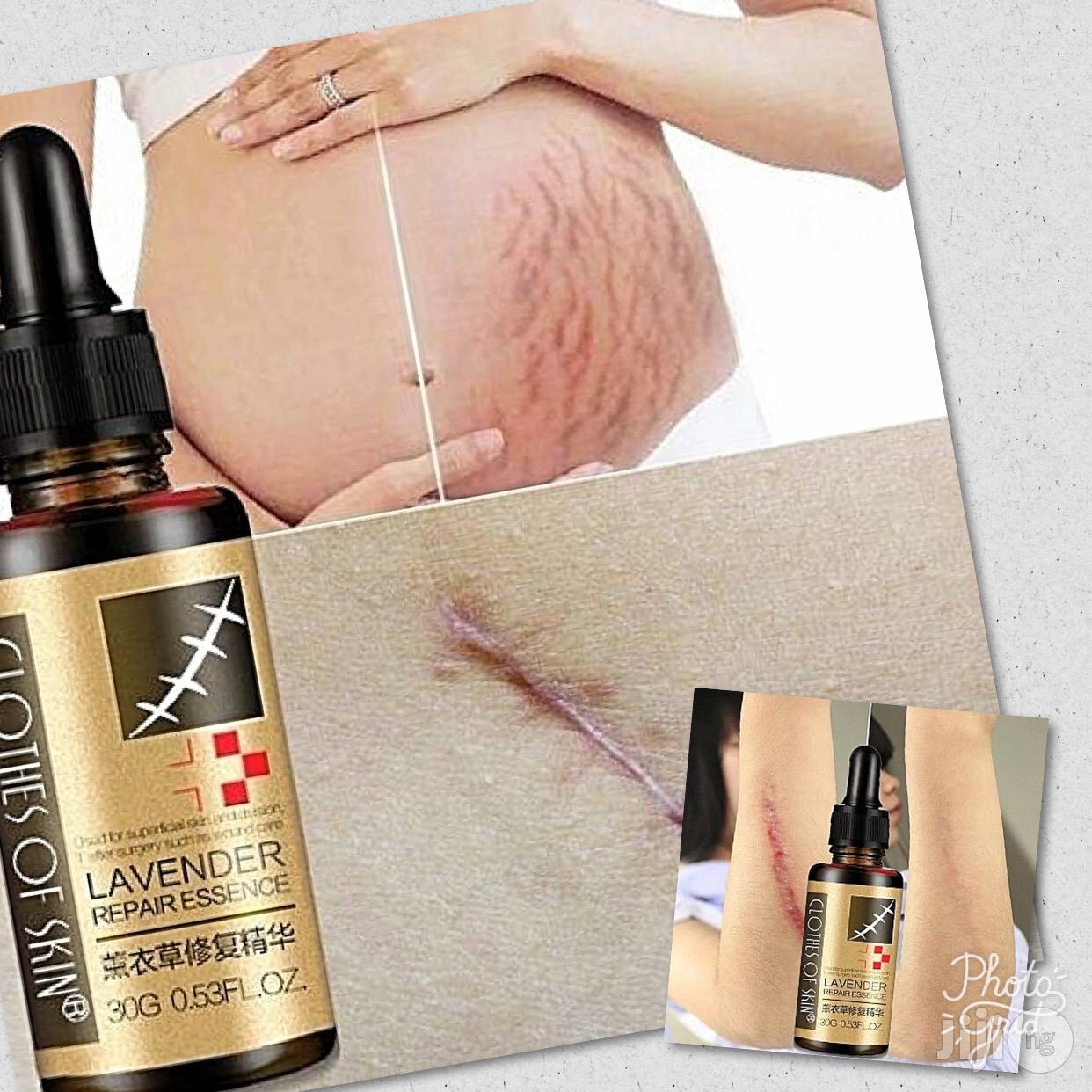 Wicked Scars And Stretch Marks Removal