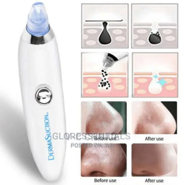 Pimples Extractor