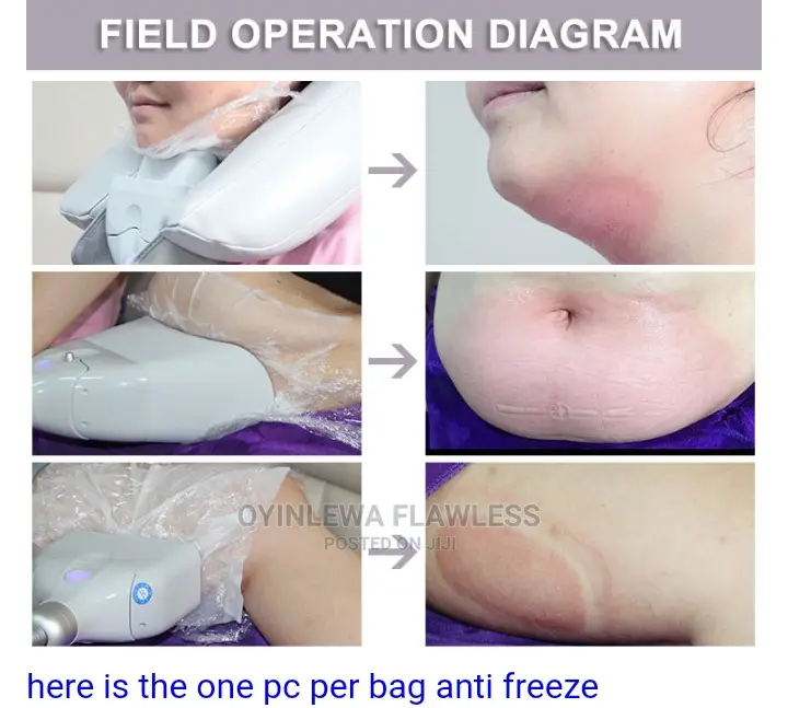 Quality Fat Freezing Cryolypolysis Membrane