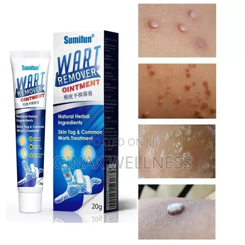 Warts Remover Ointment | Skin Tag Foot Corn Removal Cream