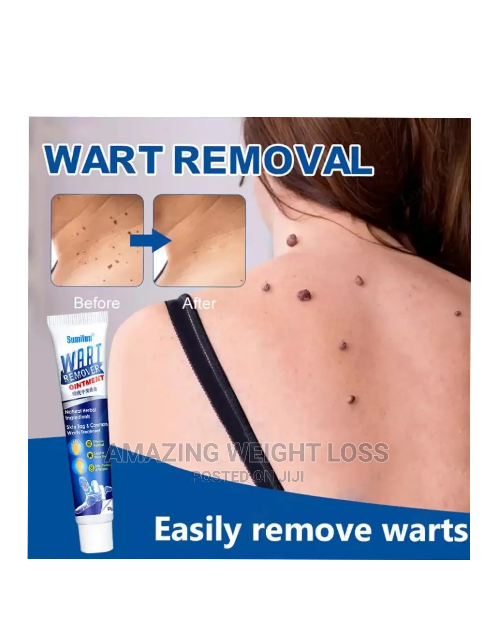 Wart Removal Cream