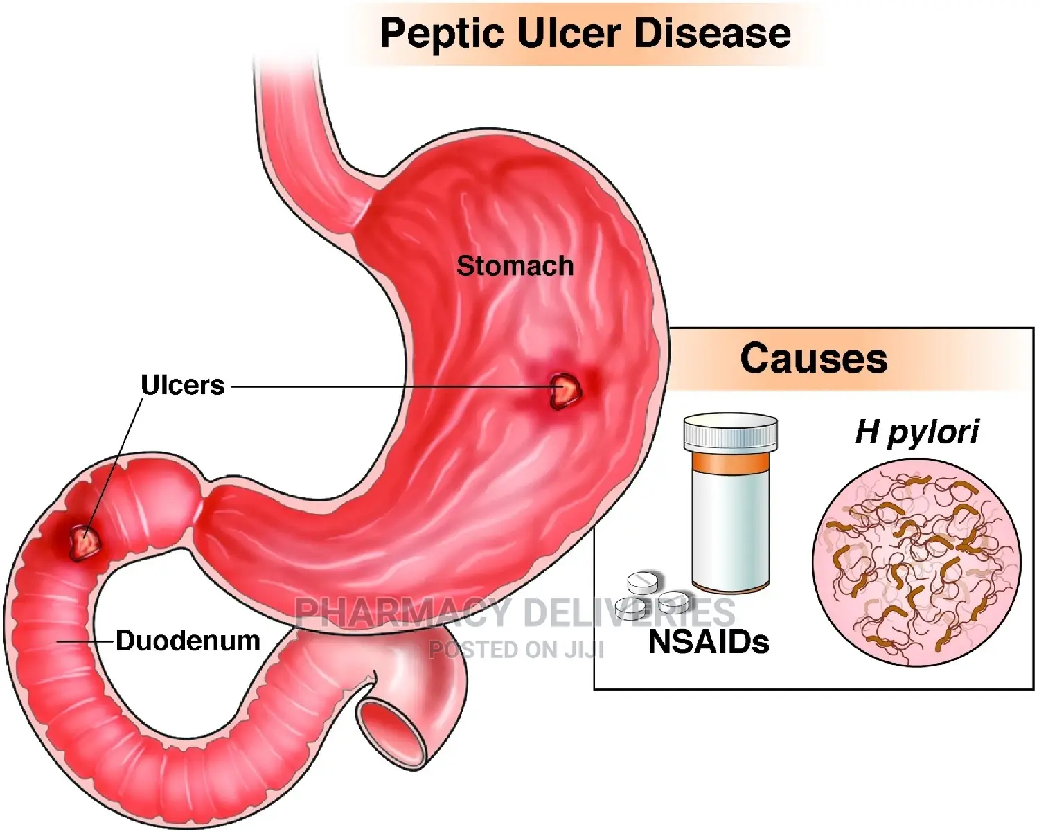 Ulcer Treatment and Medical Management Services Available
