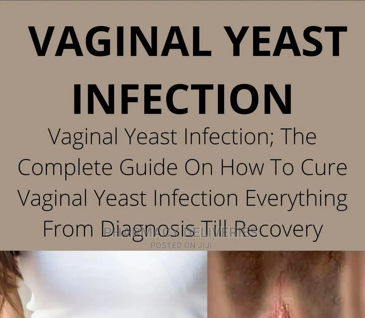 Vaginal Yeast Infection(Candidiasis) Treatment Available
