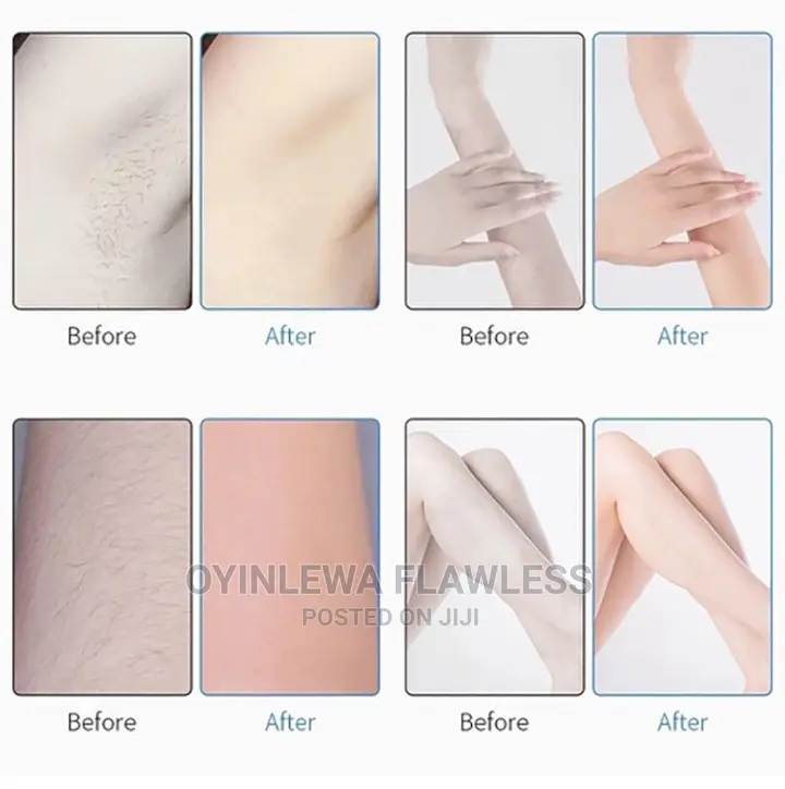 Portable Electric Epilator Ipl Laser Face Body Hair Removal