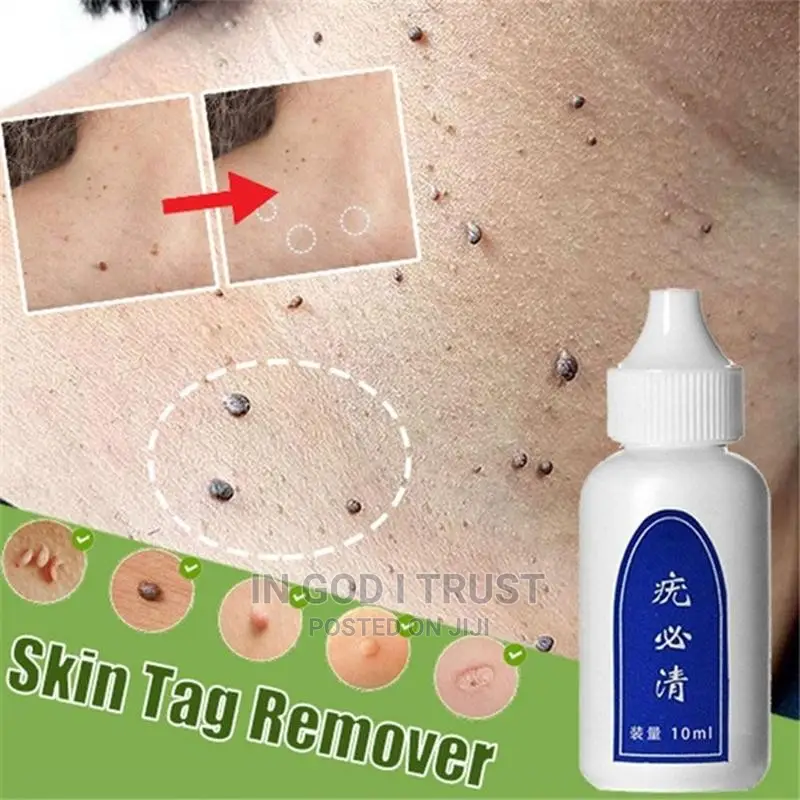 10ml Skin Tag Remover Chinese Medicine Body Warts Treatment