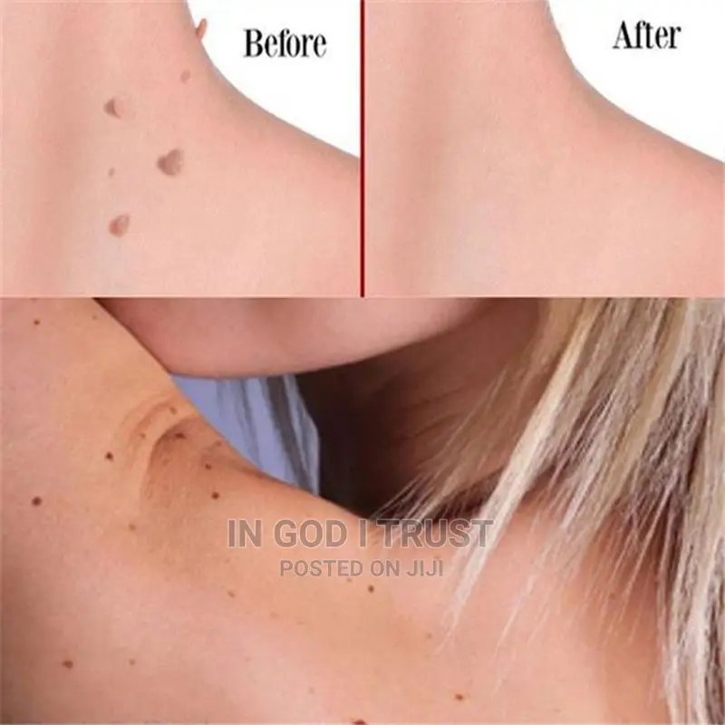 10ml Skin Tag Remover Chinese Medicine Body Warts Treatment