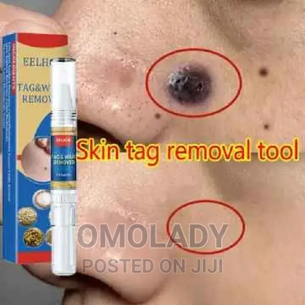 Eelhoe Tag Wart Remover - 2pc