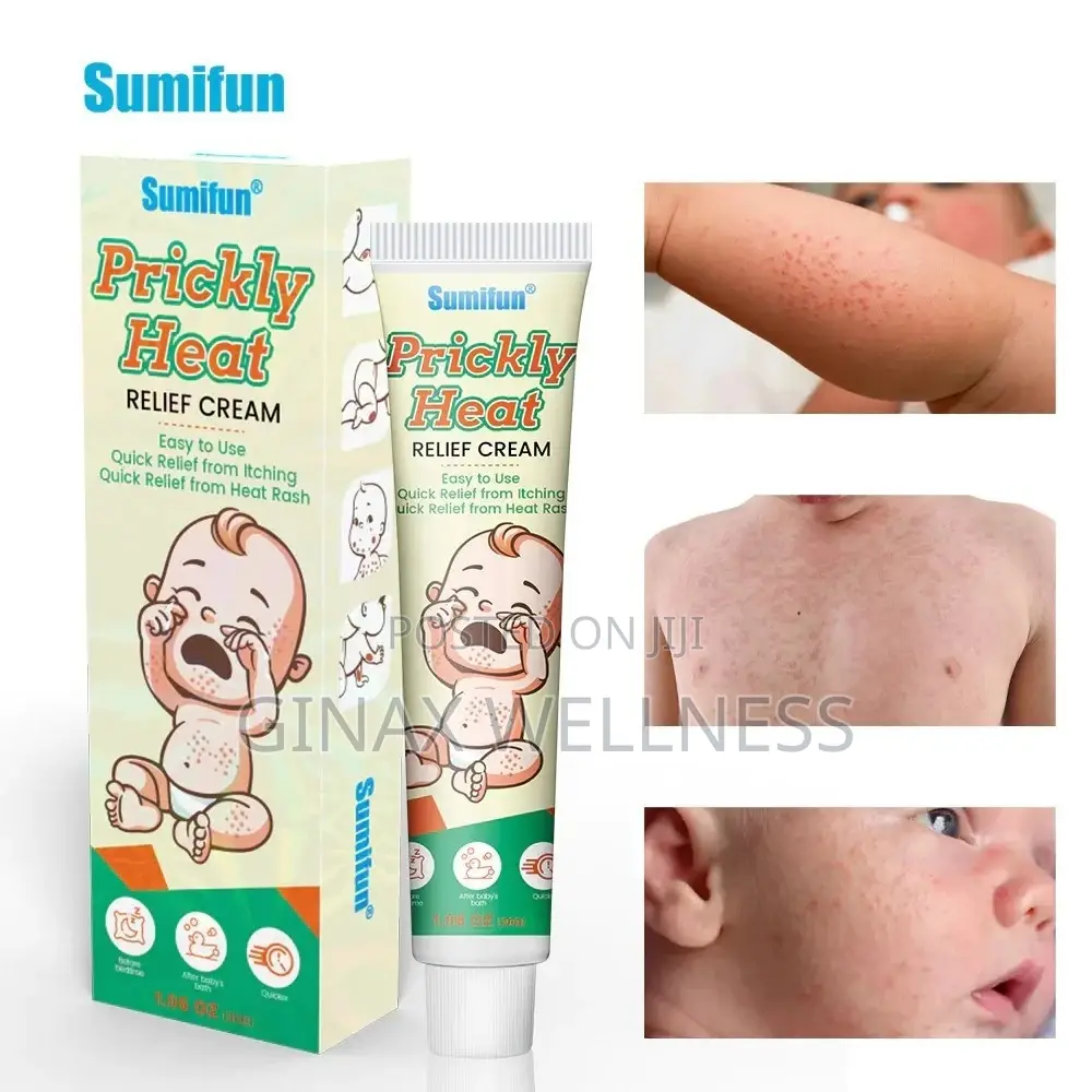Prickly Heat Relief Cream For Babies