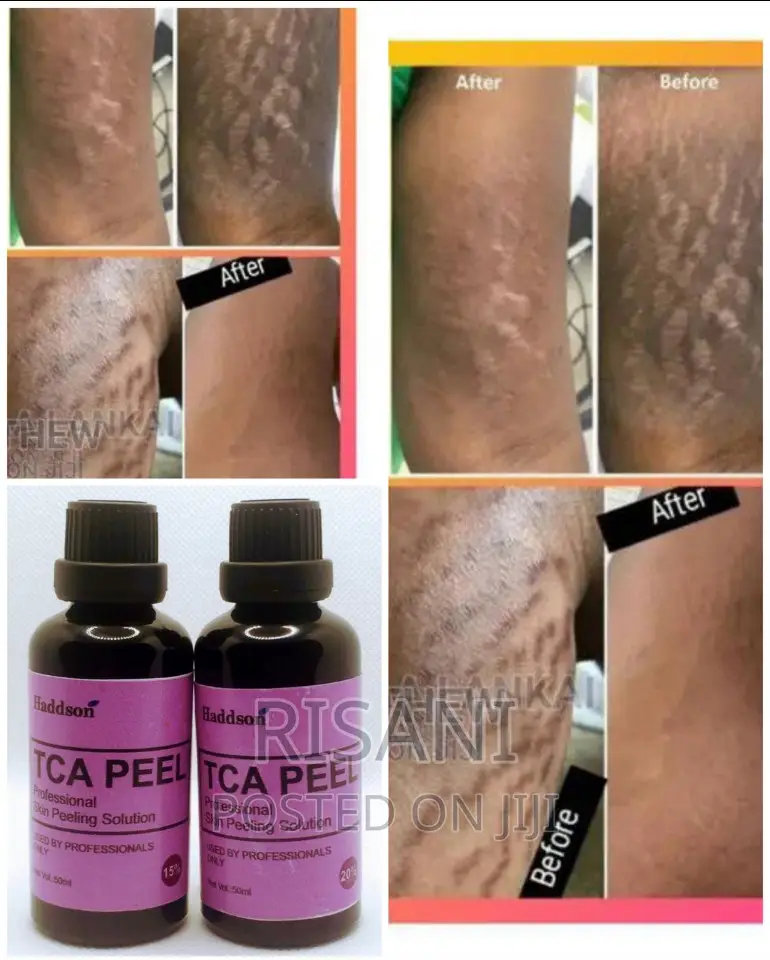 TCA Professional Chemical Peel For Stretch Marks, Acne Etc