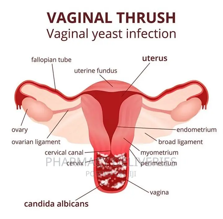PID Treatment (Pelvic Inflammatory Disease) Candidiasis