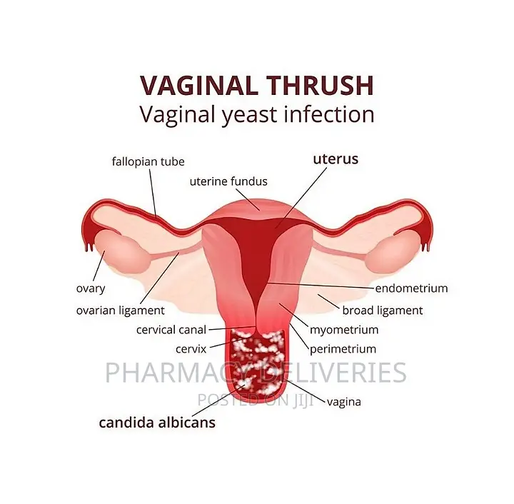 PID Treatment (Pelvic Inflammatory Disease) Candidiasis