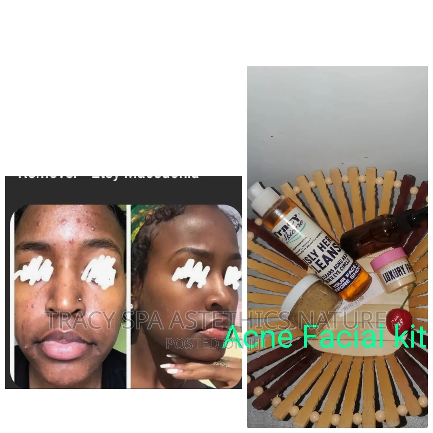 Acne/Pimples KIT