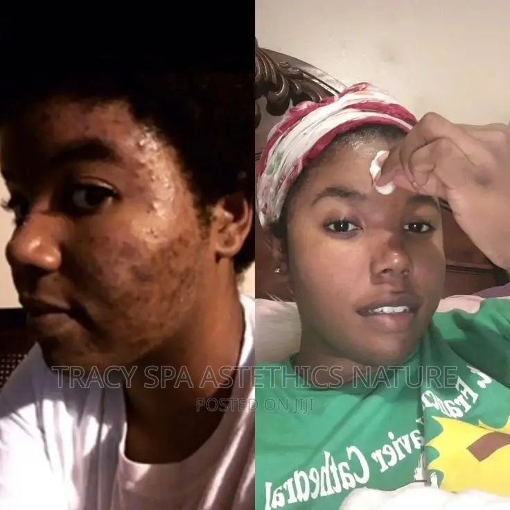 Acne Facial Treatment