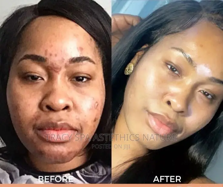 Pimples, Acnes, Blackheads And Whiteheads