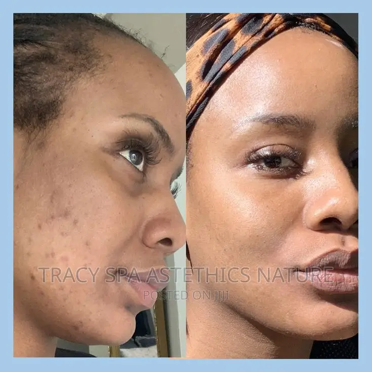 Acne Face Treay