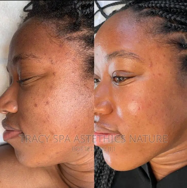 Brightening Facials