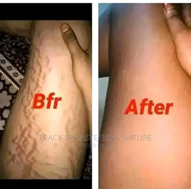 Stretch Marks Eradicate