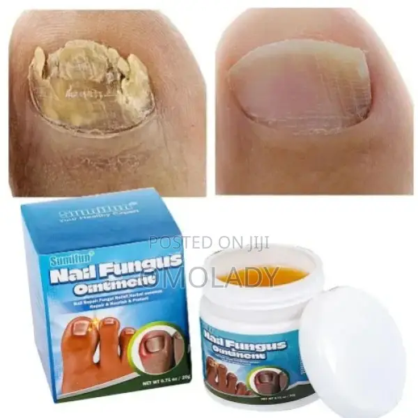 Sumifun Nail Fungus Ointment-20g