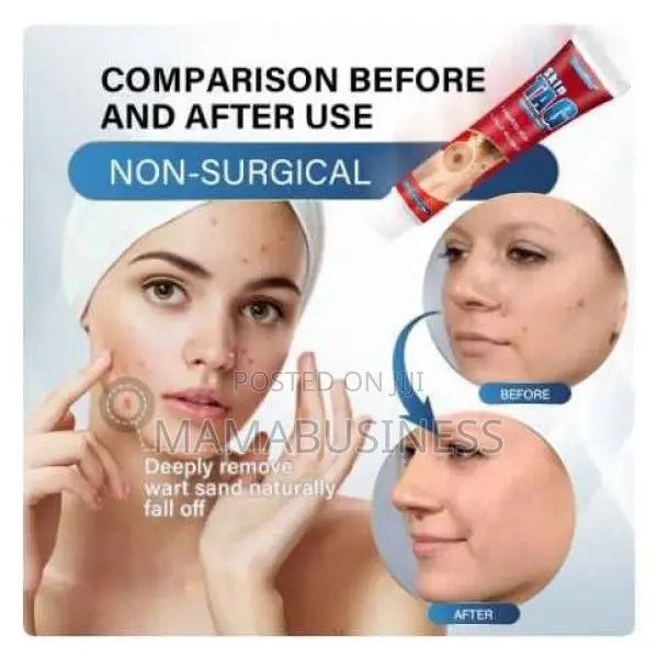 Sumifun Skin Tag Remover Cream-20g