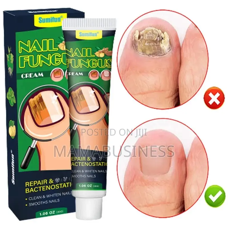 Sumifun Nail Fungus Treatment Cream-30g