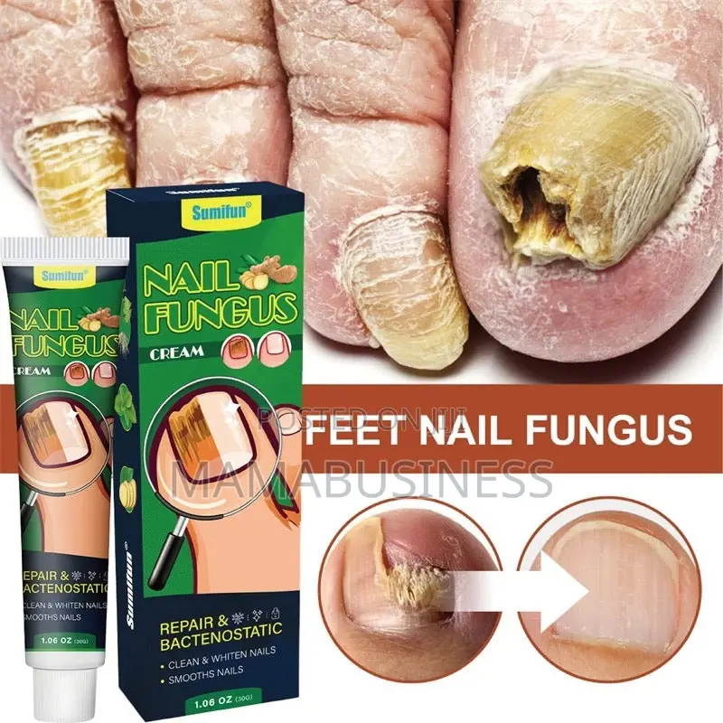 Sumifun Nail Fungus Treatment Cream-30g