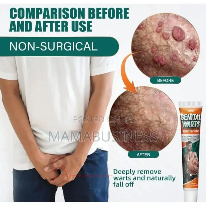 Sumifon Genital Wart Removal Cream-20g