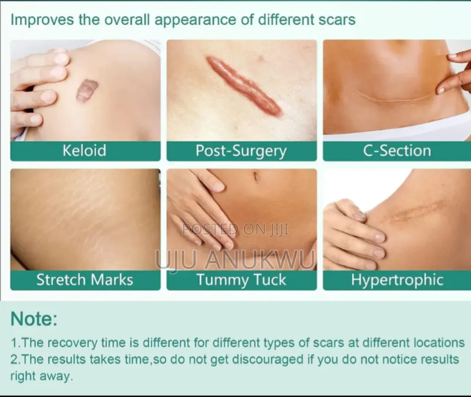 High Quality Silicone Scar Sheet For All Scars And Keloid