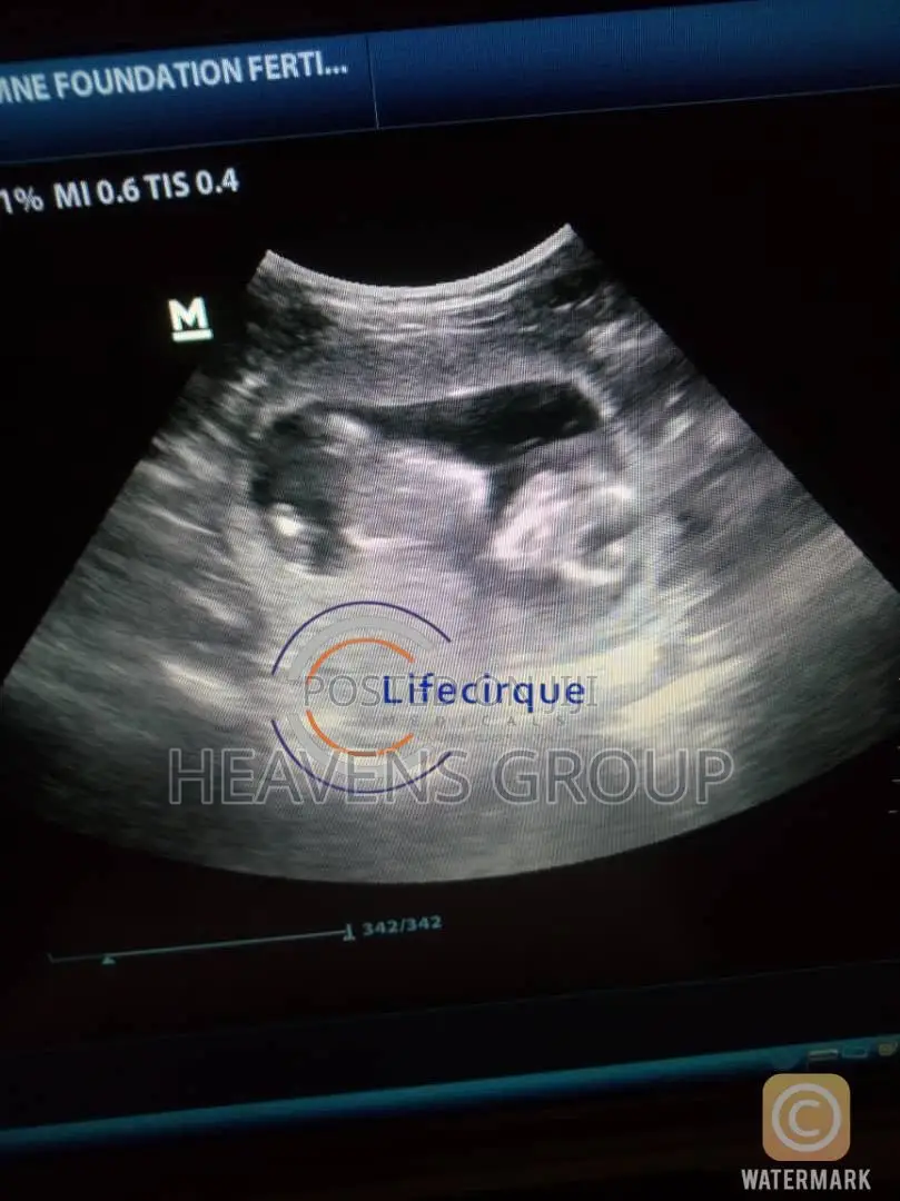 Ivf Surrogacy at Discounted Rates in Nigeria - Lifecirque