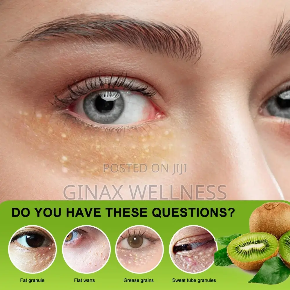 Vitamin E Fat Granules Removal Cream