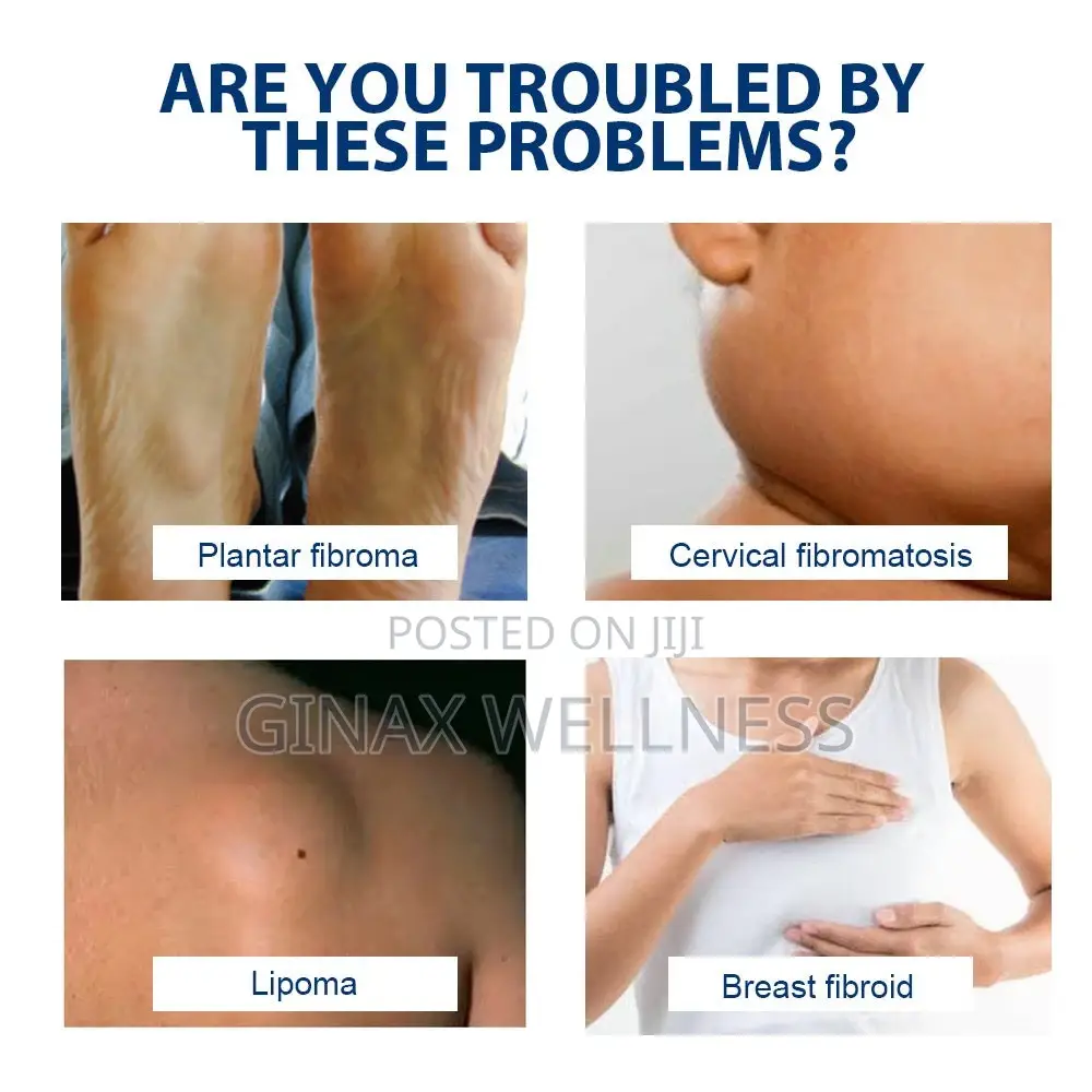 Fibroma Cream | Topical Cream for Plantar Fibroma
