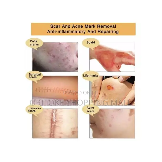 TCM Scar, Stretch Marks and Acne Removal Gel!(SKIN REPAIR )