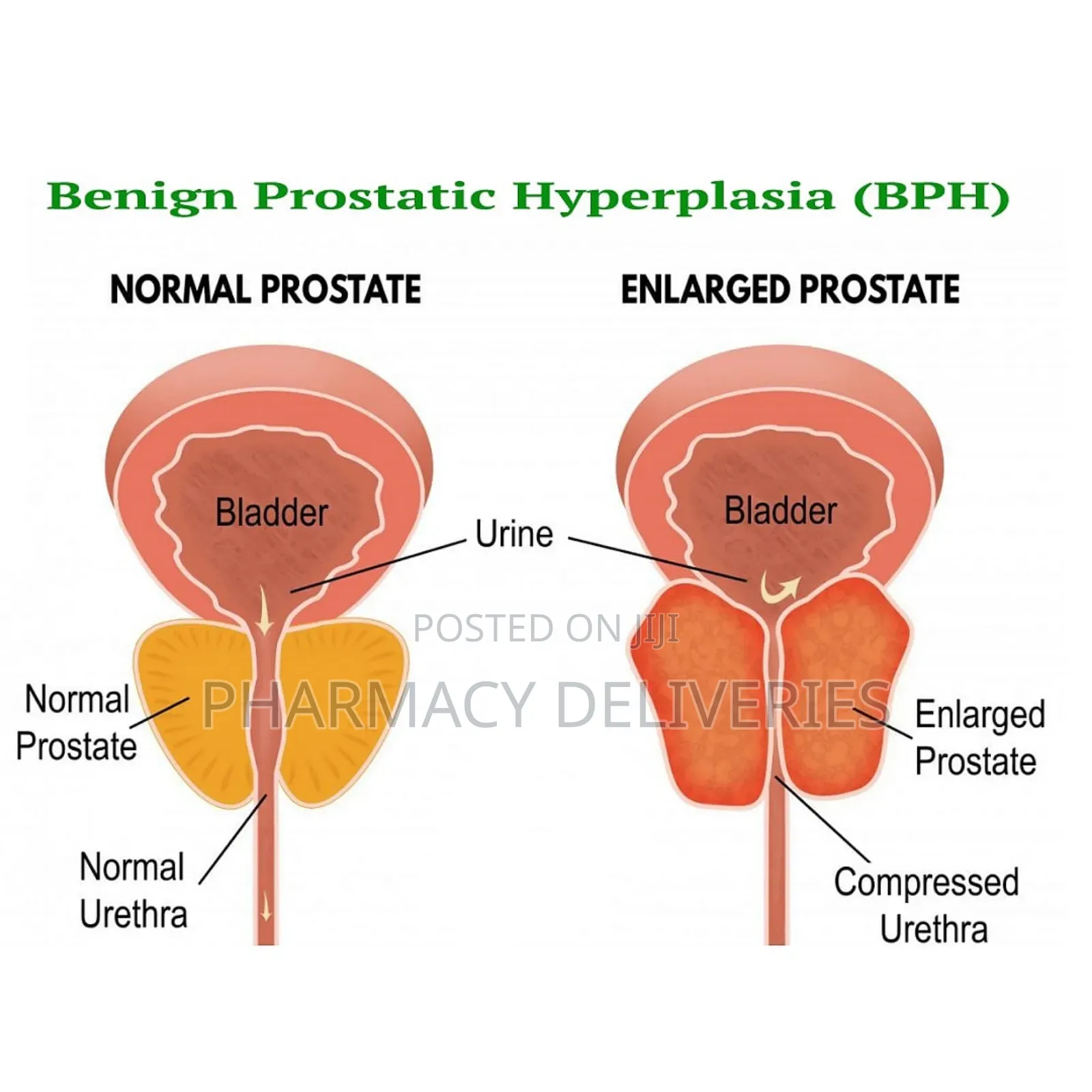 Prostate Growth Treatment With Natural Supplement Available